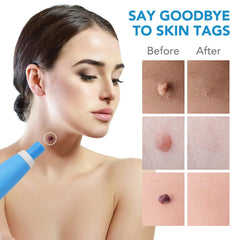 2-in-1 Skin Tag & Mole Remover Device