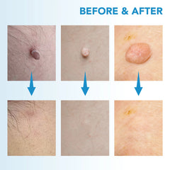 2-in-1 Skin Tag & Mole Remover Device